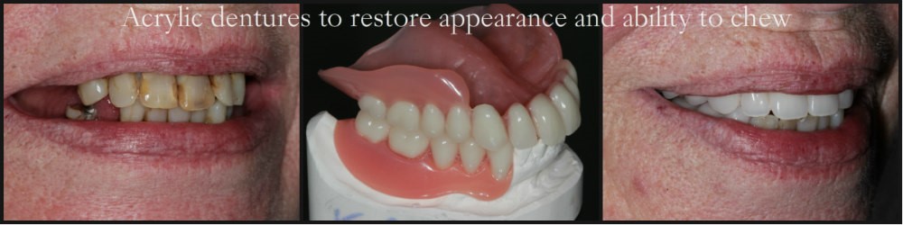 Permanent Dentures Procedure Lincoln NH 3251